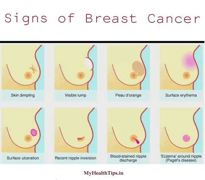 10 Breast Cancer Facts | New Life Ticket - Part 2
