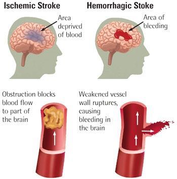 Take the Steps  for Stroke Awareness