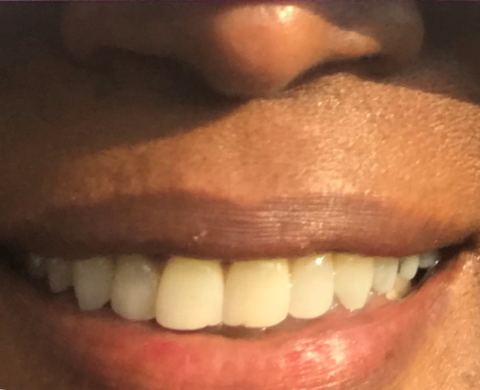 Smile Brilliant Teeth Whitening Before Use Photo
