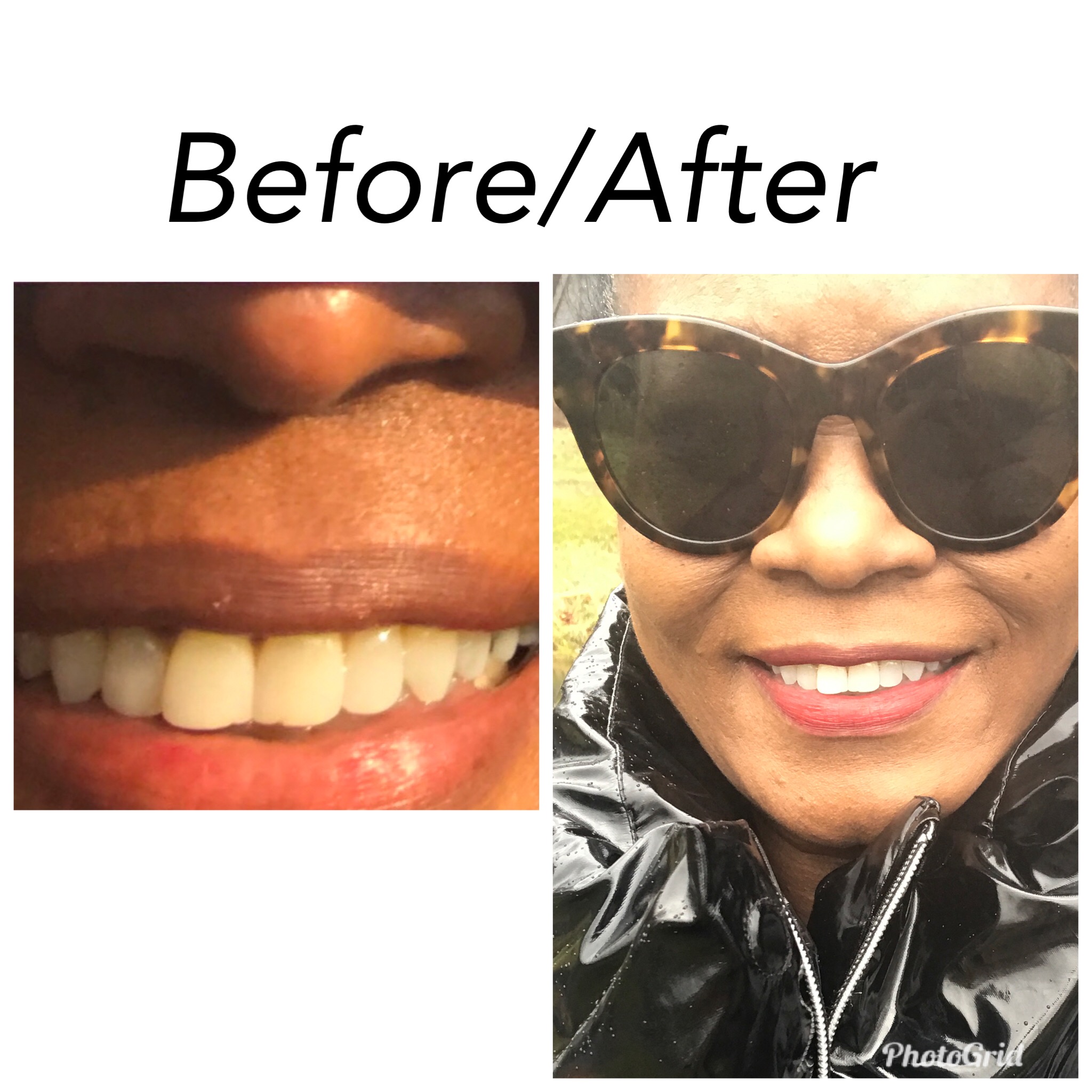 Before and After Smile Brillant