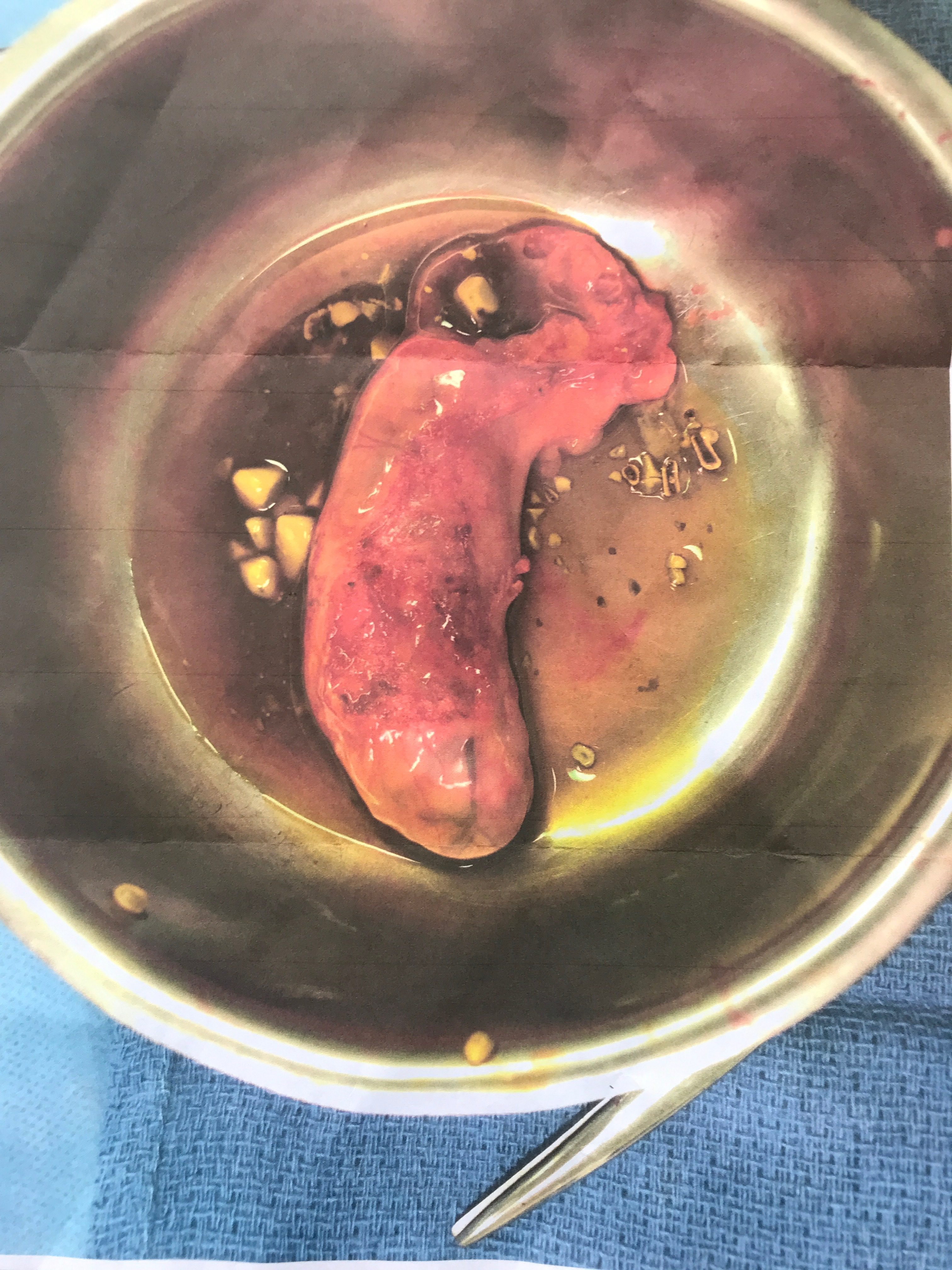 My Inflamed and Diseased Gallbladder with Gallstones