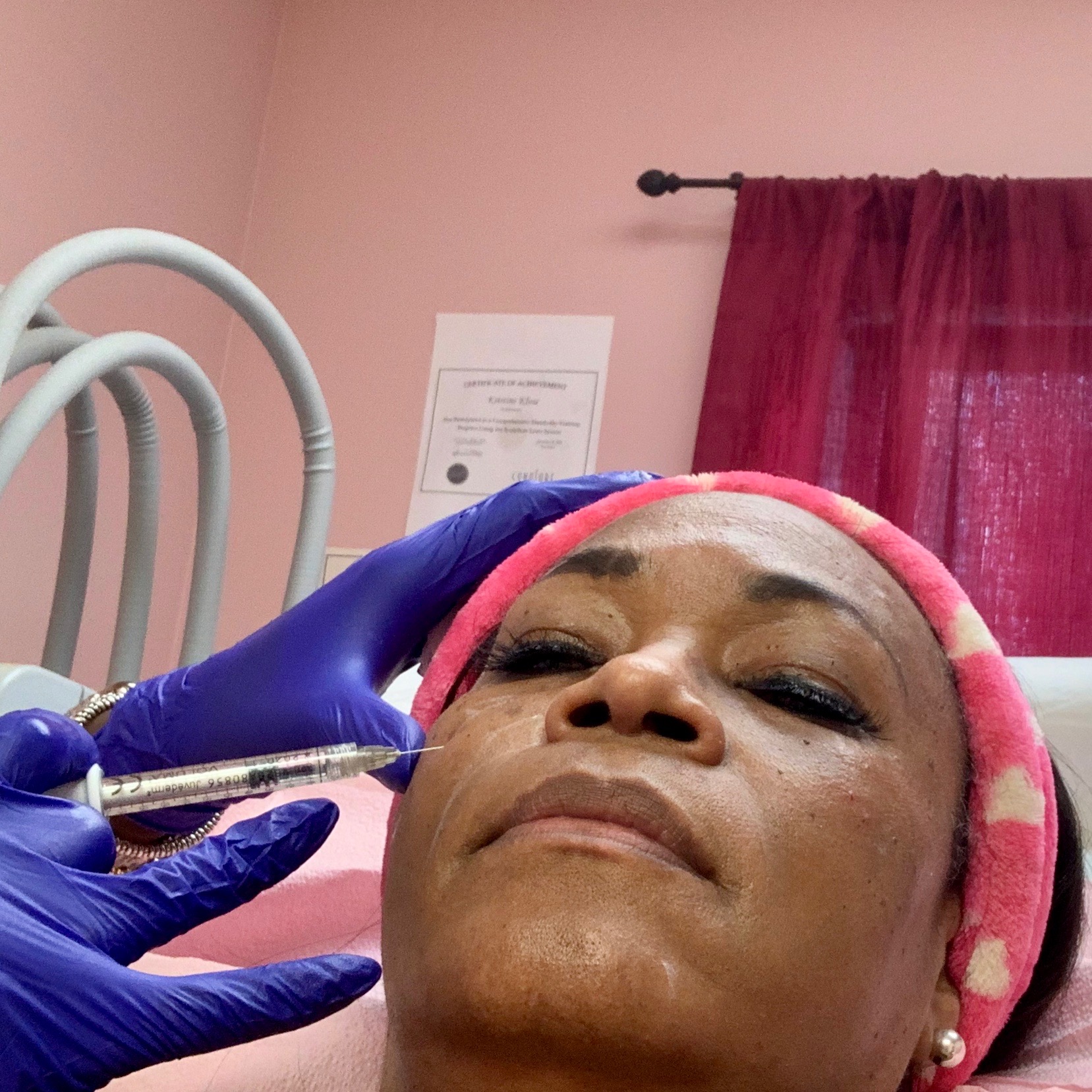 My First Juvéderm Injection at CD Aesthics & Wellness, Harrisburg, PA