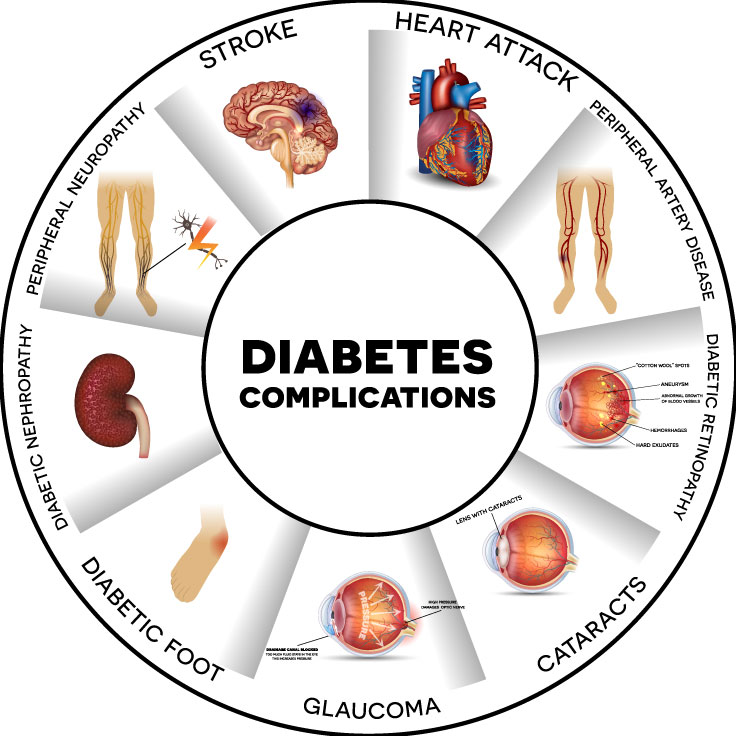 Complications of Type 2 Diabetes; Sugary Foods